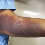 InternalBleeding InternalBleeding
