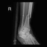 X-Ray2 X-Ray2