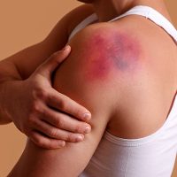 Injured_Bruises3